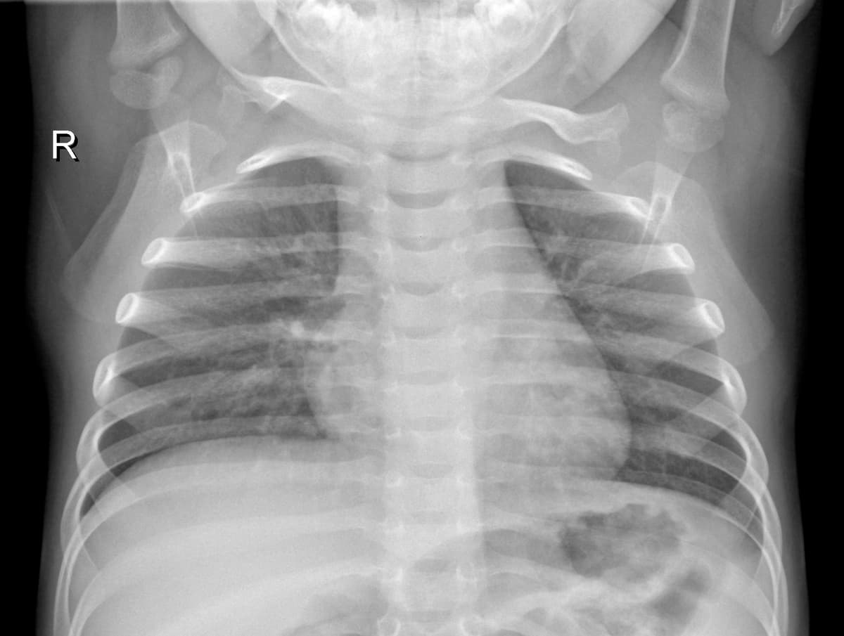 Radiografia Normal — NIH Chest X-ray14