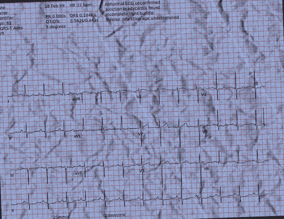 Normal ECG — PTB-XL