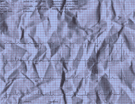 Normal ECG — PTB-XL