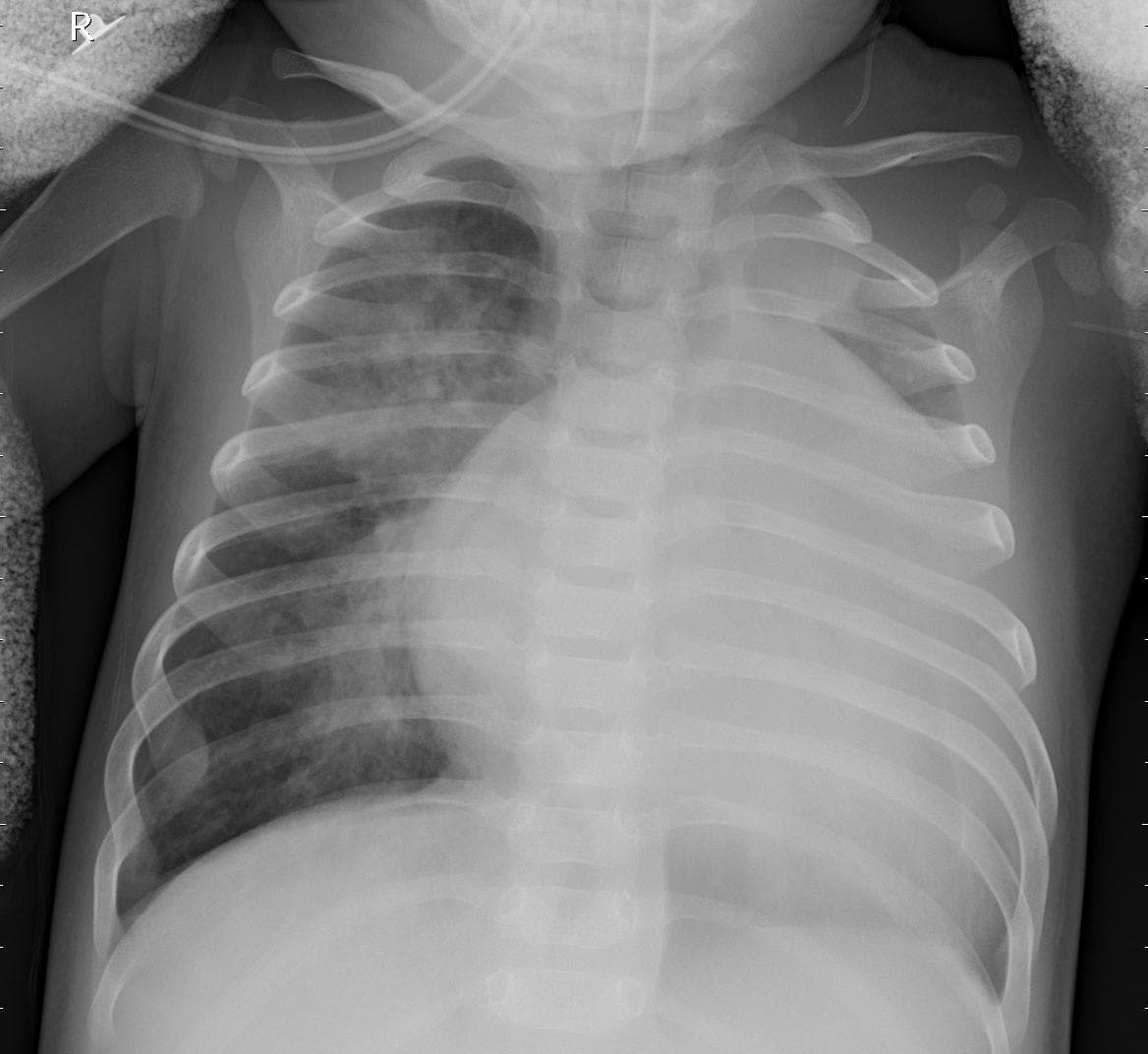 Pneumonia — NIH Chest X-ray14