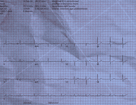 Normal ECG — PTB-XL