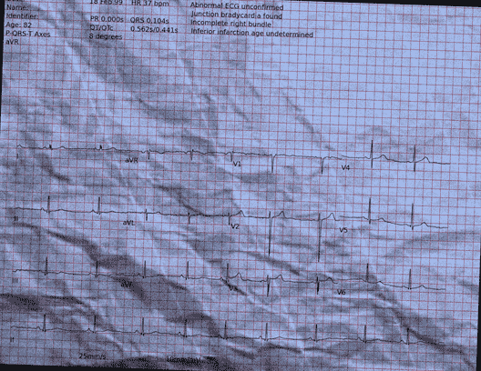 Normal ECG — PTB-XL