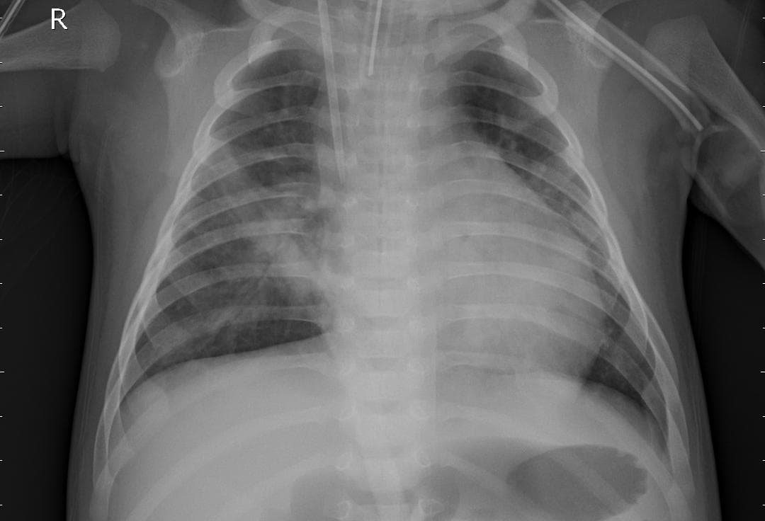 Pneumonia — NIH Chest X-ray14