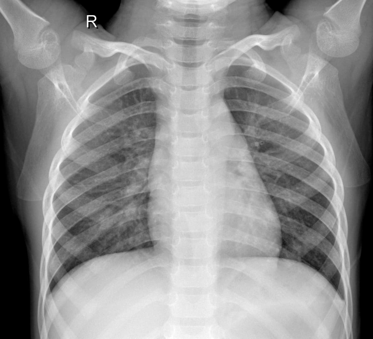 Radiografia Normal — NIH Chest X-ray14