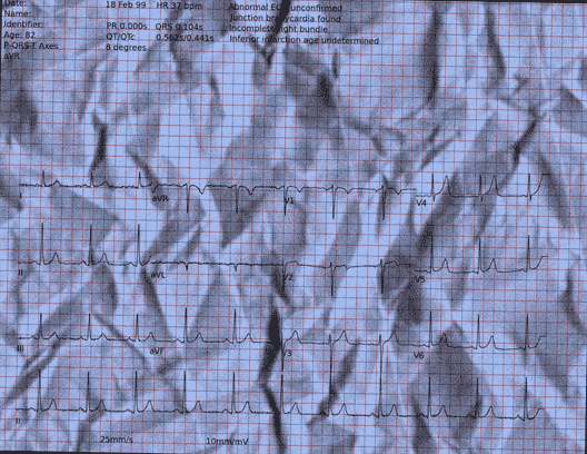 Normal ECG — PTB-XL