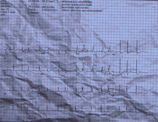 Normal ECG — PTB-XL