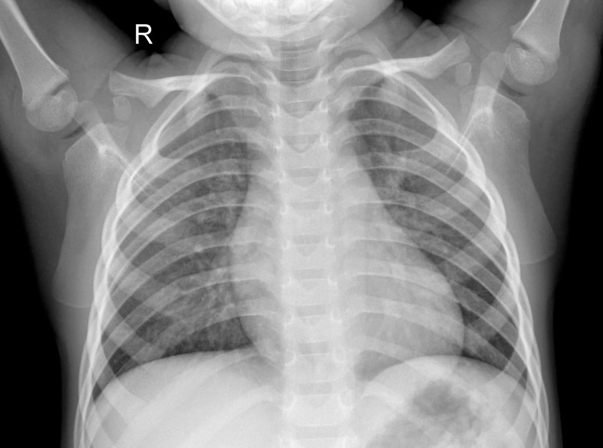 Radiografia Normal — NIH Chest X-ray14