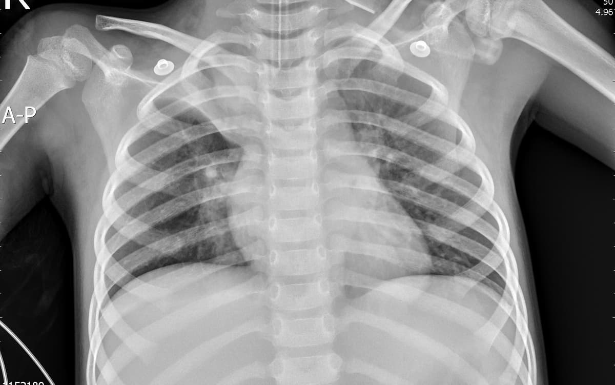 Pneumonia — NIH Chest X-ray14