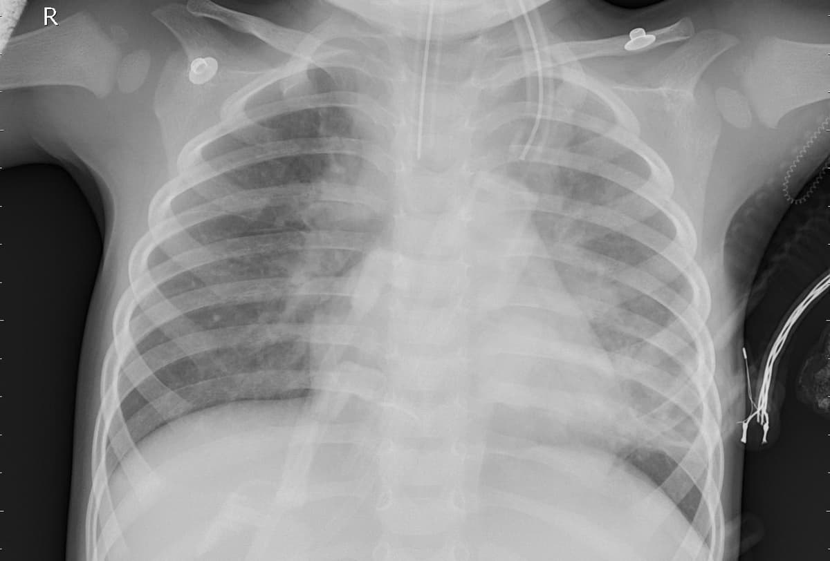 Pneumonia — NIH Chest X-ray14