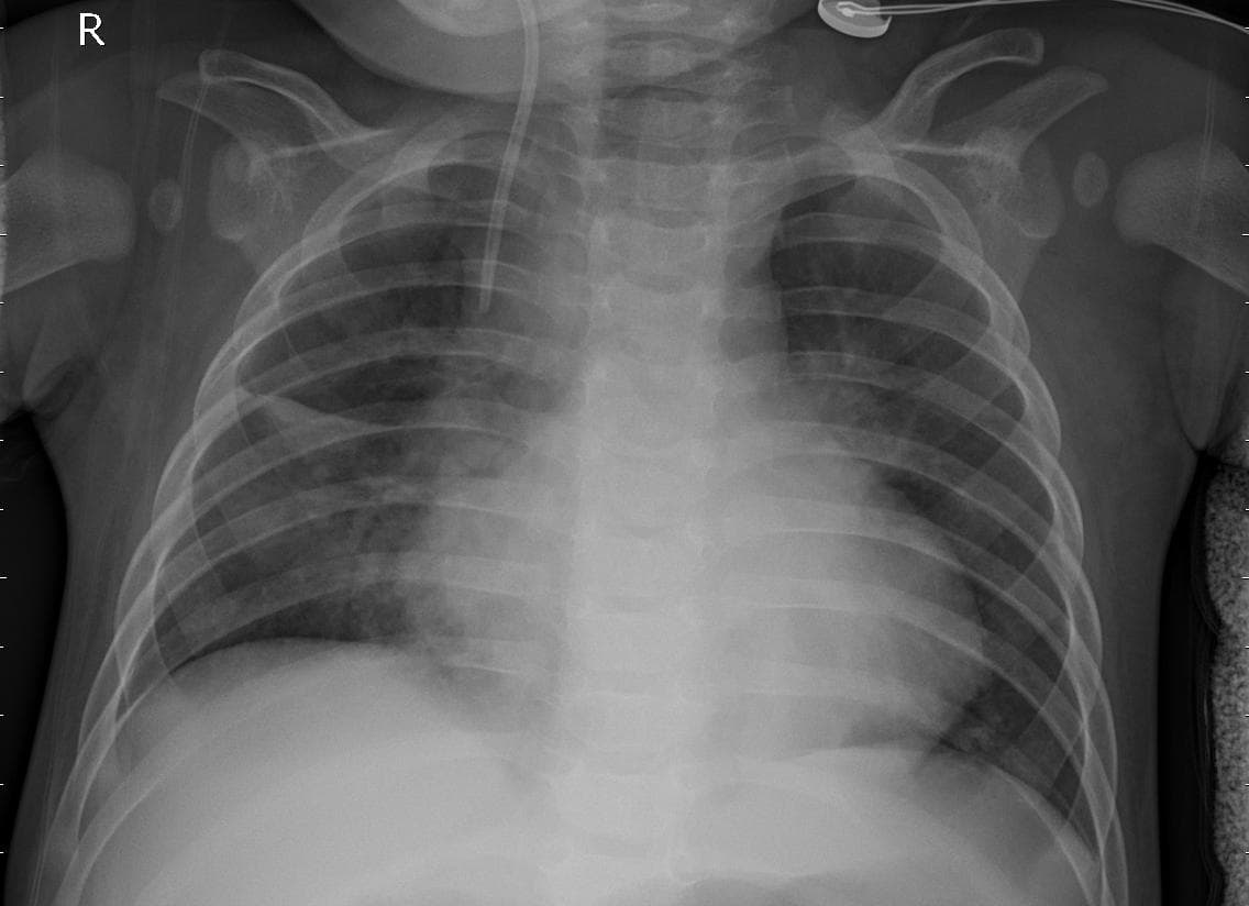 Pneumonia — NIH Chest X-ray14