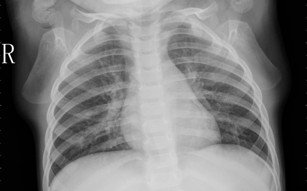 Pneumonia — NIH Chest X-ray14