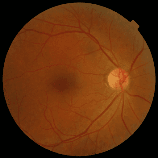 No Diabetic Retinopathy — MESSIDOR-2