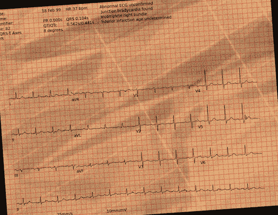 Normal ECG — PTB-XL