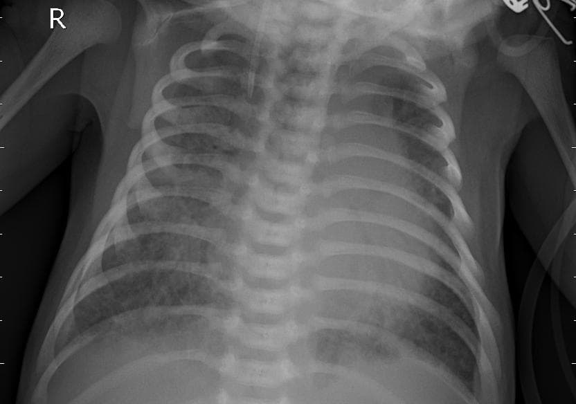 Pneumonia — NIH Chest X-ray14
