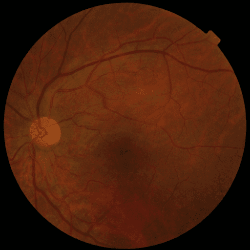 No Diabetic Retinopathy — MESSIDOR-2