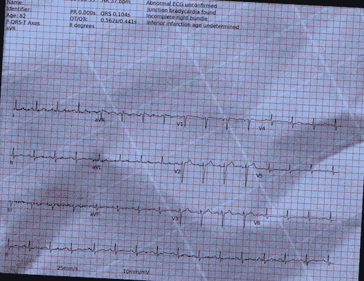 Normal ECG — PTB-XL