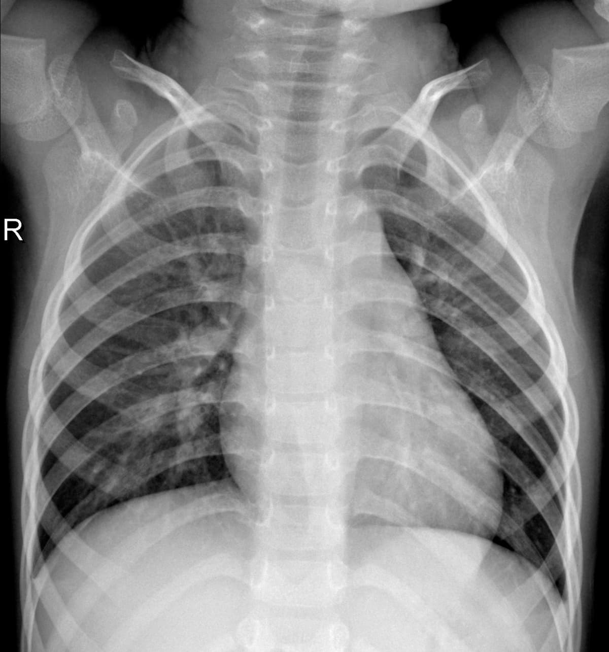 Radiografia Normal — NIH Chest X-ray14