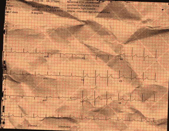 Normal ECG — PTB-XL