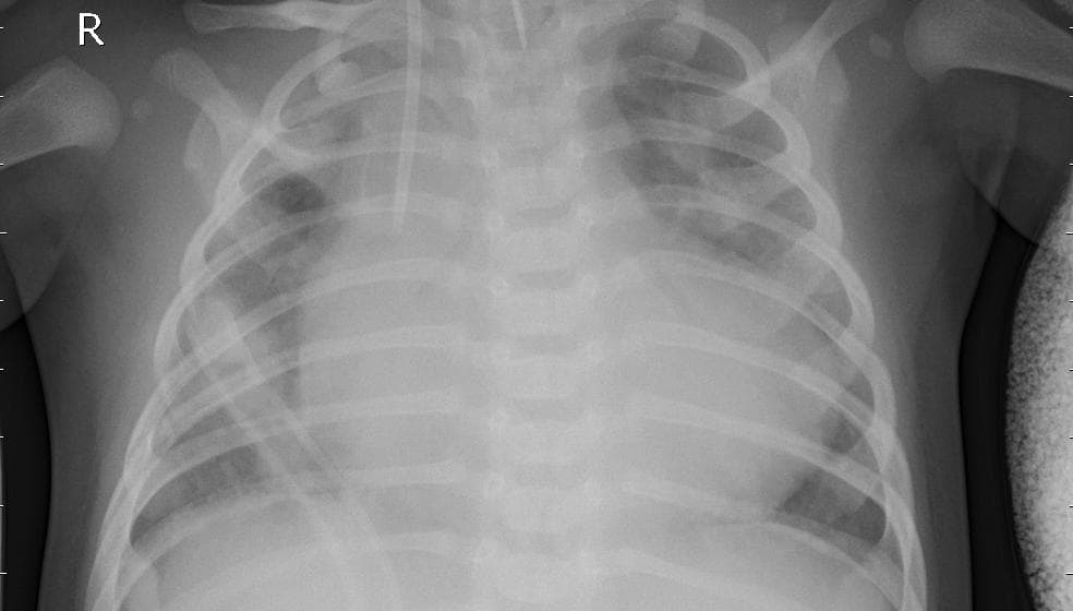 Pneumonia — NIH Chest X-ray14