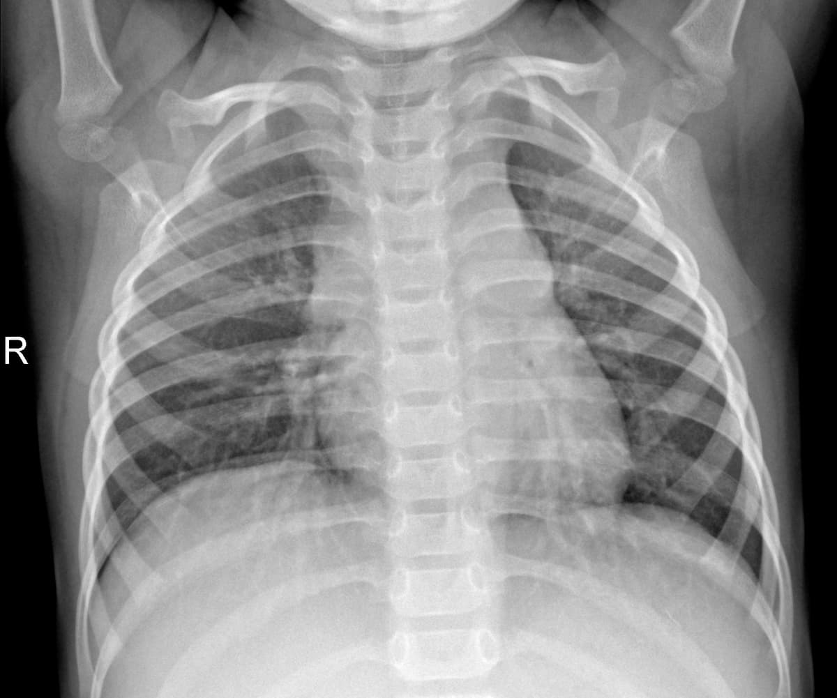 Radiografia Normal — NIH Chest X-ray14