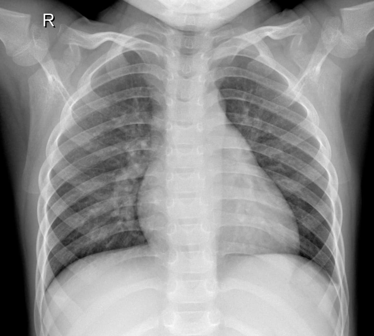 Radiografia Normal — NIH Chest X-ray14