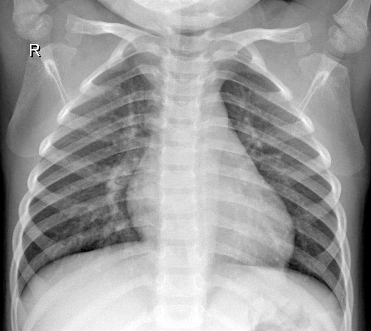 Radiografia Normal — NIH Chest X-ray14