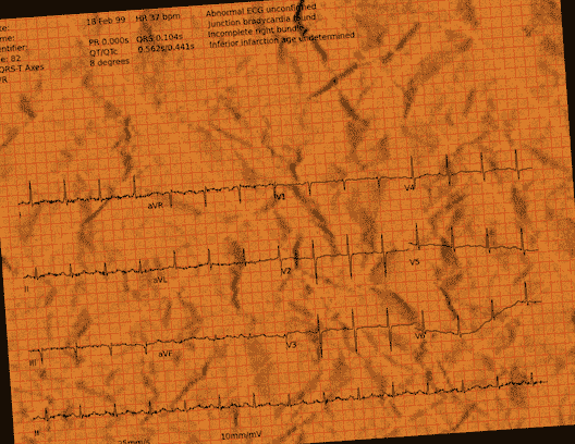 Normal ECG — PTB-XL