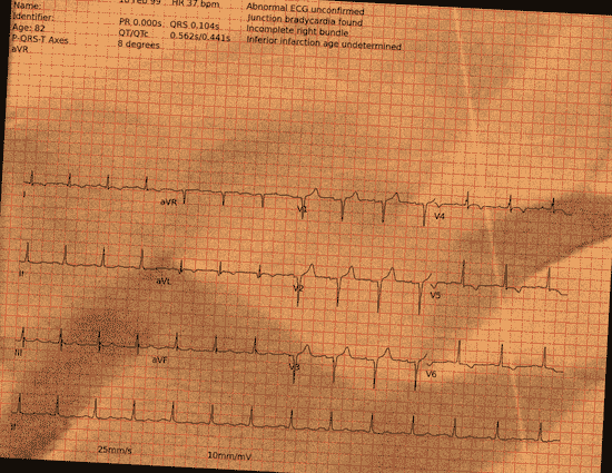 Normal ECG — PTB-XL