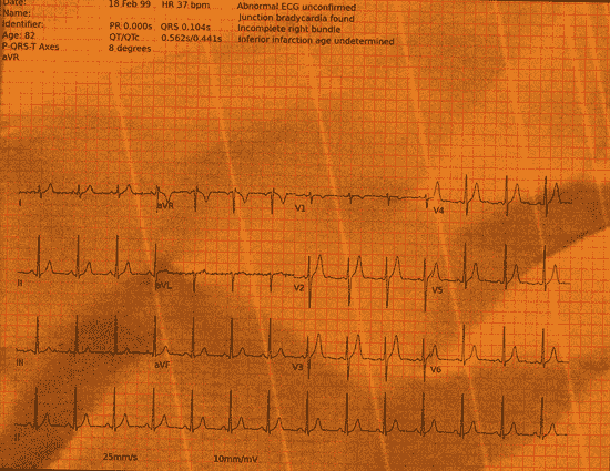 Normal ECG — PTB-XL