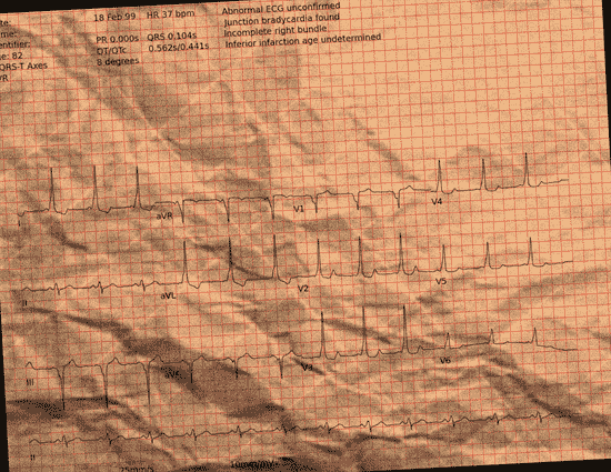 Normal ECG — PTB-XL