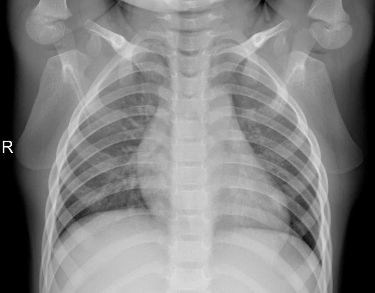 Radiografia Normal — NIH Chest X-ray14