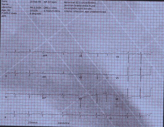 Normal ECG — PTB-XL