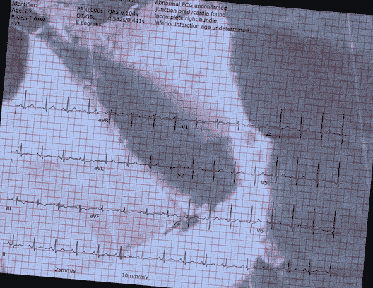 Normal ECG — PTB-XL