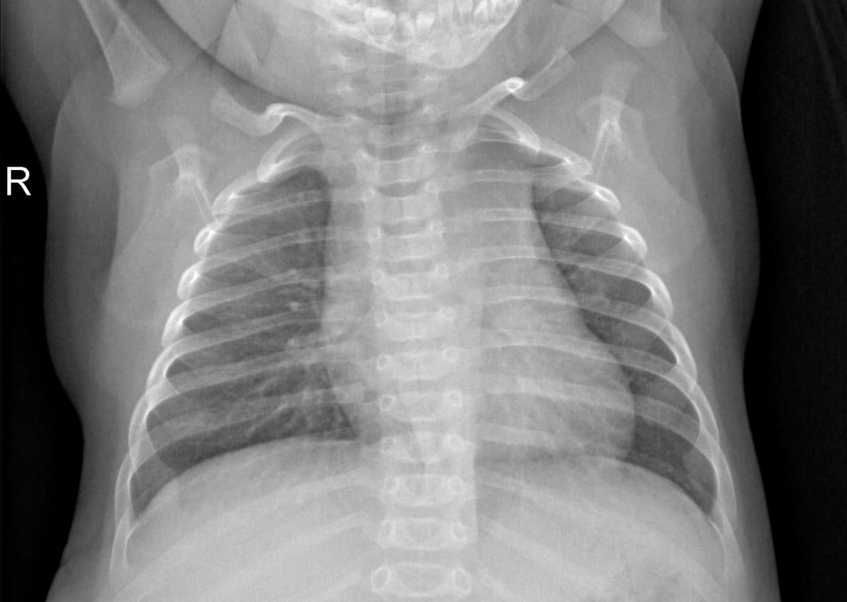 Radiografia Normal — NIH Chest X-ray14