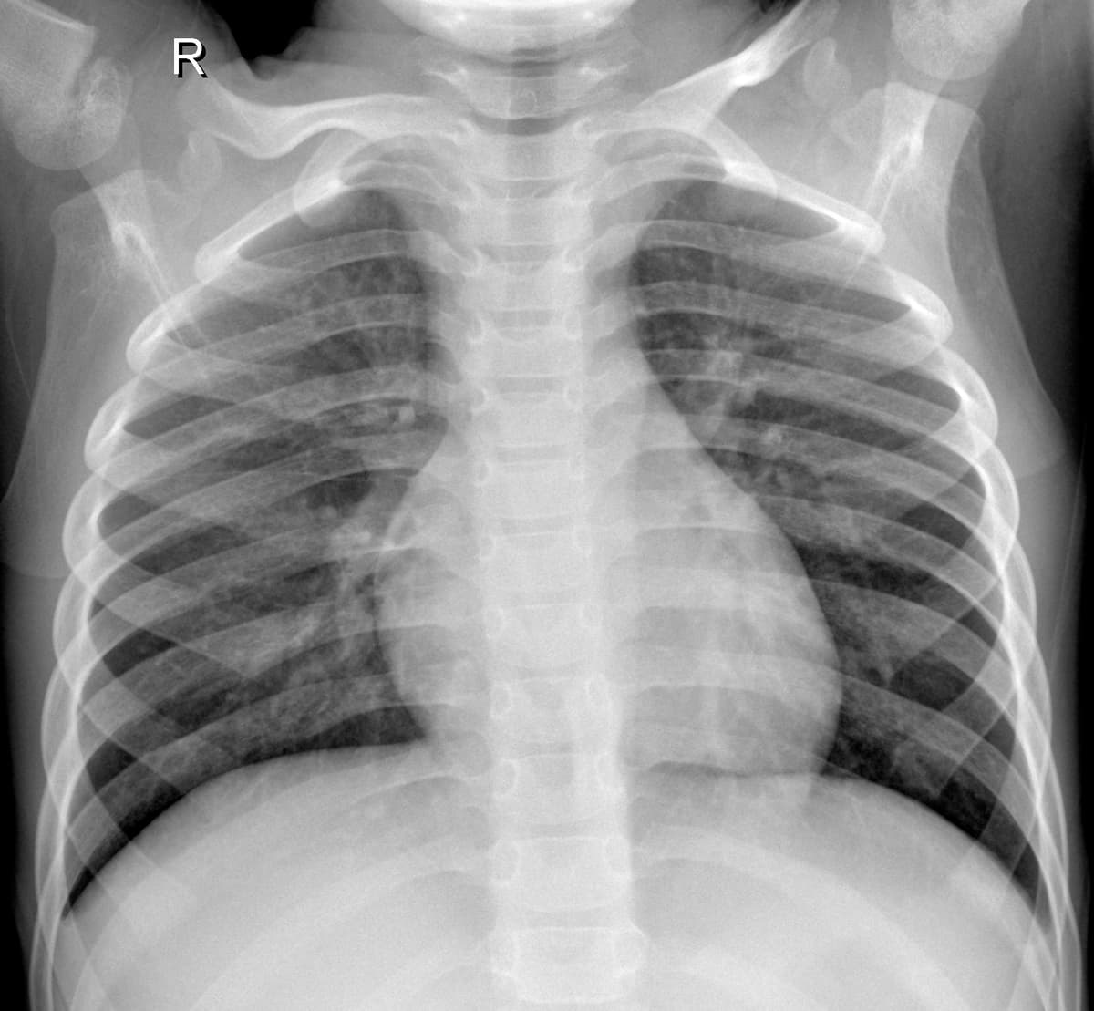 Radiografia Normal — NIH Chest X-ray14