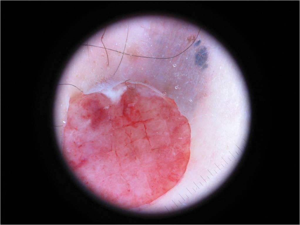 Actinic Keratosis — ISIC Archive