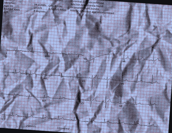 Normal ECG — PTB-XL