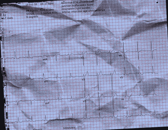 Normal ECG — PTB-XL