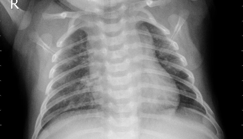Pneumonia — NIH Chest X-ray14