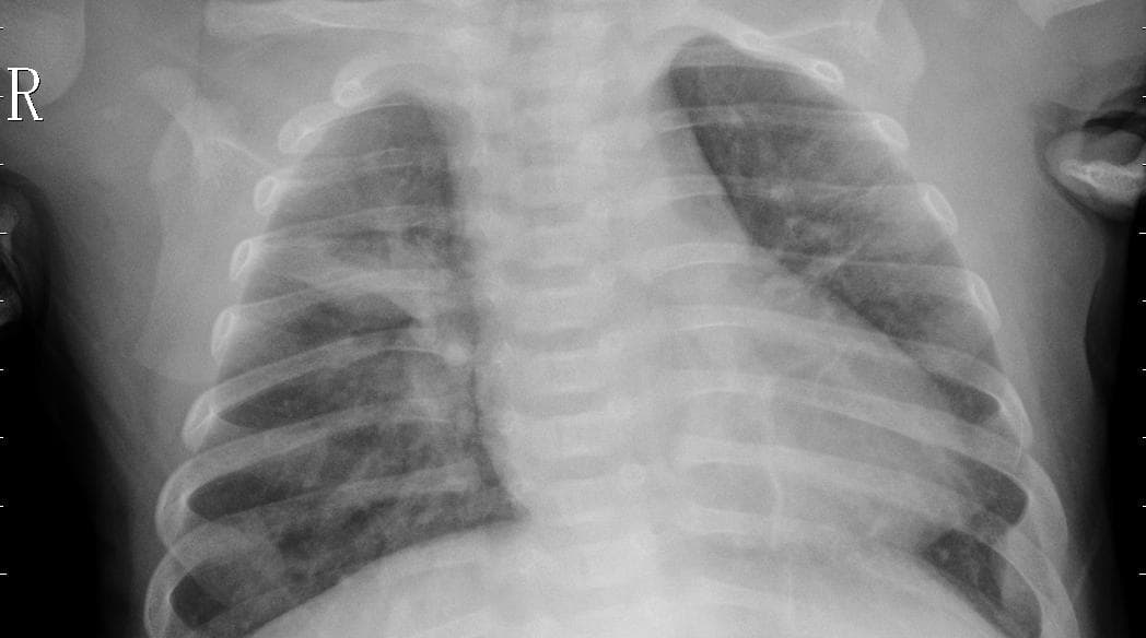Pneumonia — NIH Chest X-ray14