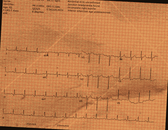 Normal ECG — PTB-XL