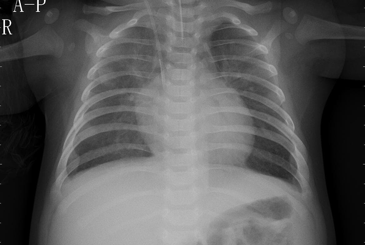 Pneumonia — NIH Chest X-ray14
