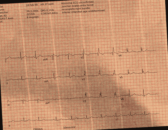Normal ECG — PTB-XL