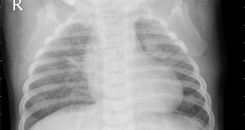 Pneumonia — NIH Chest X-ray14
