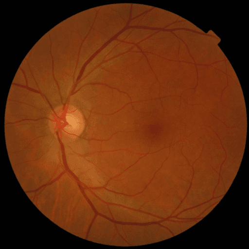 No Diabetic Retinopathy — MESSIDOR-2