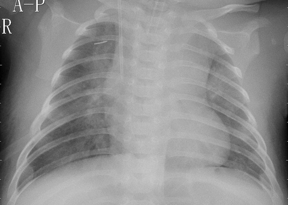 Pneumonia — NIH Chest X-ray14