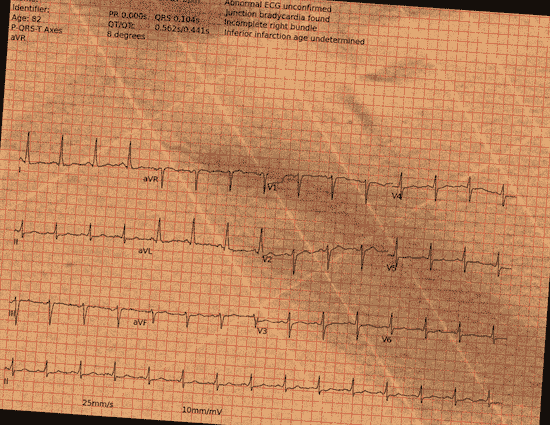 Normal ECG — PTB-XL