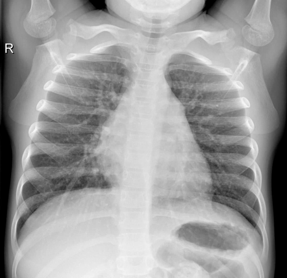 Radiografia Normal — NIH Chest X-ray14
