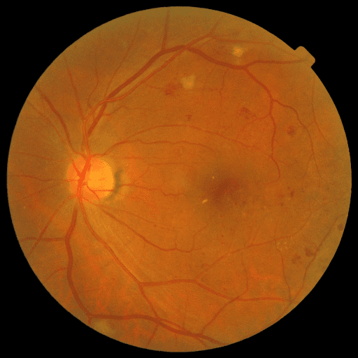 Proliferative DR — MESSIDOR-2