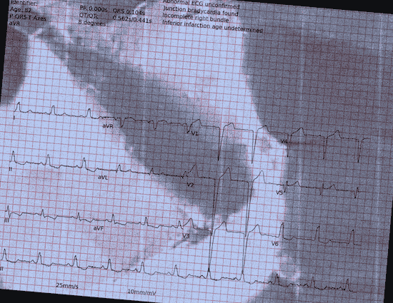 Normal ECG — PTB-XL